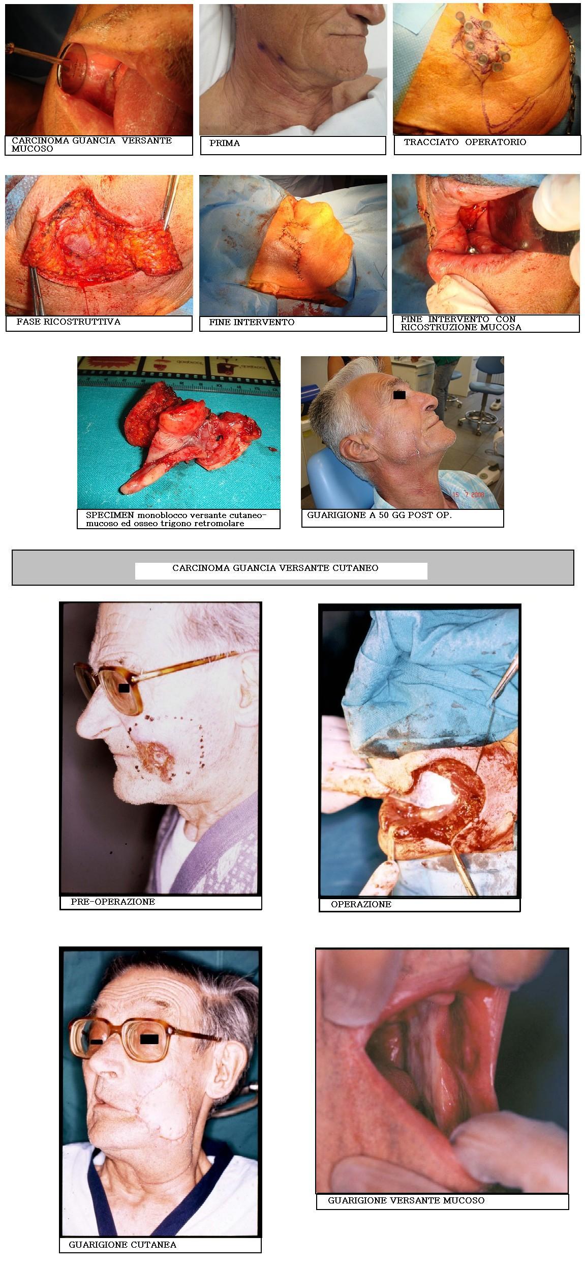 Chirurgia Carcinoma guancia