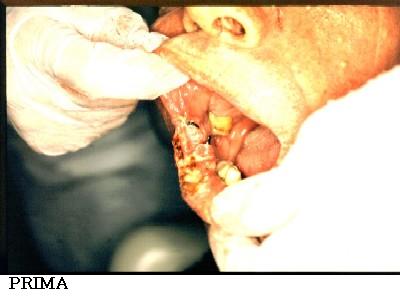Dott. Bux CHIRURGIA Carcinoma labbro 1