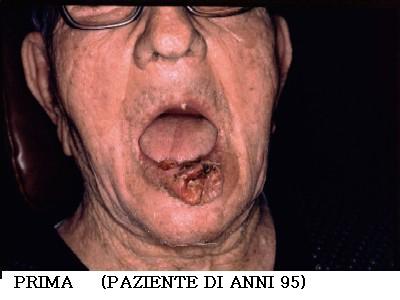 Dott. Bux CHIRURGIA Carcinoma labbro 2
