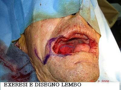 Dott. Bux CHIRURGIA Carcinoma labbro 3
