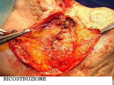 Dott. Bux CHIRURGIA Carcinoma labbro 3