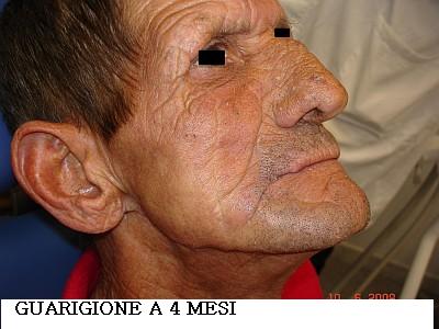 Dott. Bux CHIRURGIA Carcinoma labbro 3