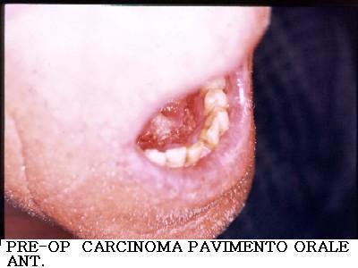 Chirurgia Carcinoma pelvi orale ant.