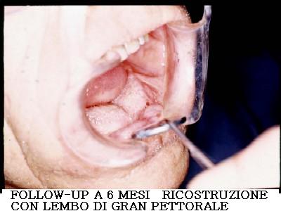 Chirurgia Carcinoma pelvi orale ant.