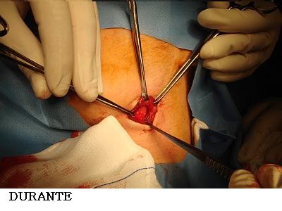 Chirurgia calcolosi ghiandola sottomascellare